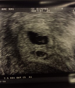 1st Ultrasound - Baby Sacs III