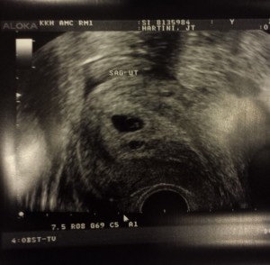 1st Ultrasound - Baby Sacs I