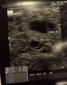 1st Ultrasound - Baby Sacs II